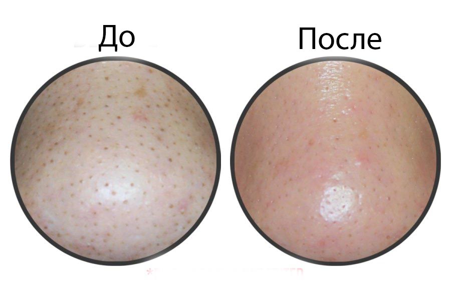 Салфетки для удаления черных точек Ciracle Blackhead Off Sheet - фото 5